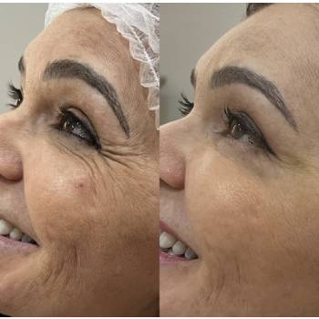 Botox Na Testa em Cotia