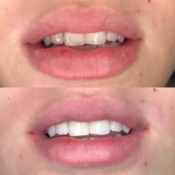 Clareamento Dental a Laser em Campo Limpo