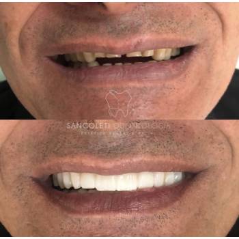 Faceta De Porcelana na Aclimação