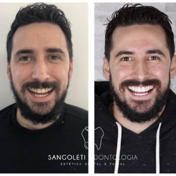 Facetas De Porcelana Preço