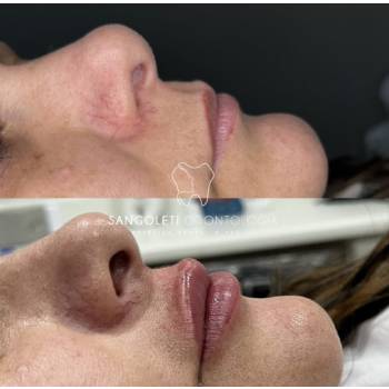 Harmonização Orofacial em São João - Guarulhos