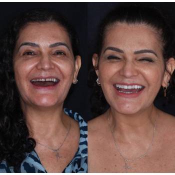 Lente De Contato Dental Resina no Morumbi