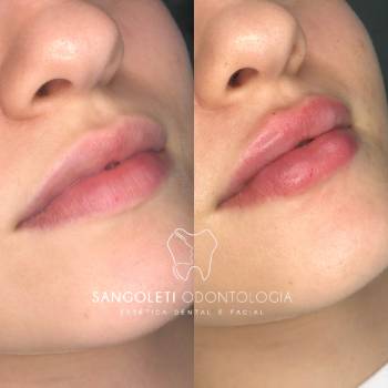 Preenchimento Labial Com Ácido Hialurônico na Santa Ifigênia