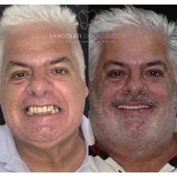 Protese Dentaria Parafusada em Lauzane Paulista