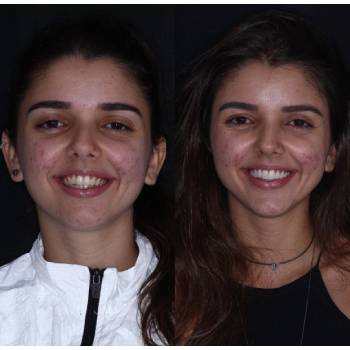 Valor Lente De Contato Dental Resina em Guarulhos