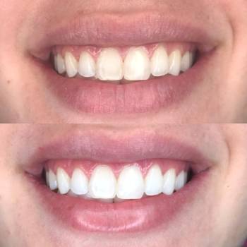 Clareamento Dental Preço